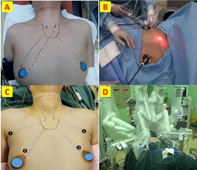 Robotic bilateral axillo-breast versus endoscopic bilateral areola thyroidectomy outcomes of 757 patients